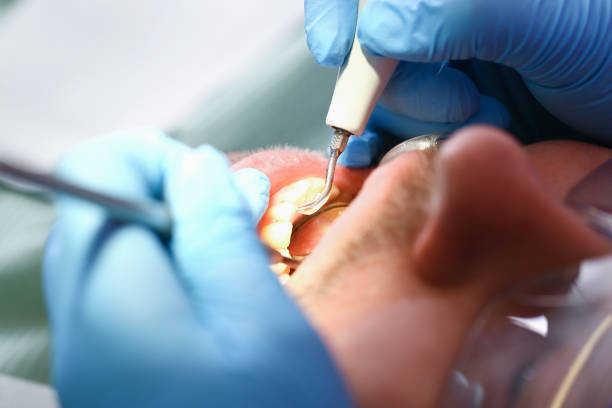 Best Emergency Dentist for Knocked-Out Tooth in Alderson, WV